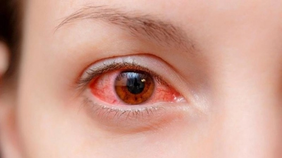 Đau mắt đỏ và một số vấn đề cần biết